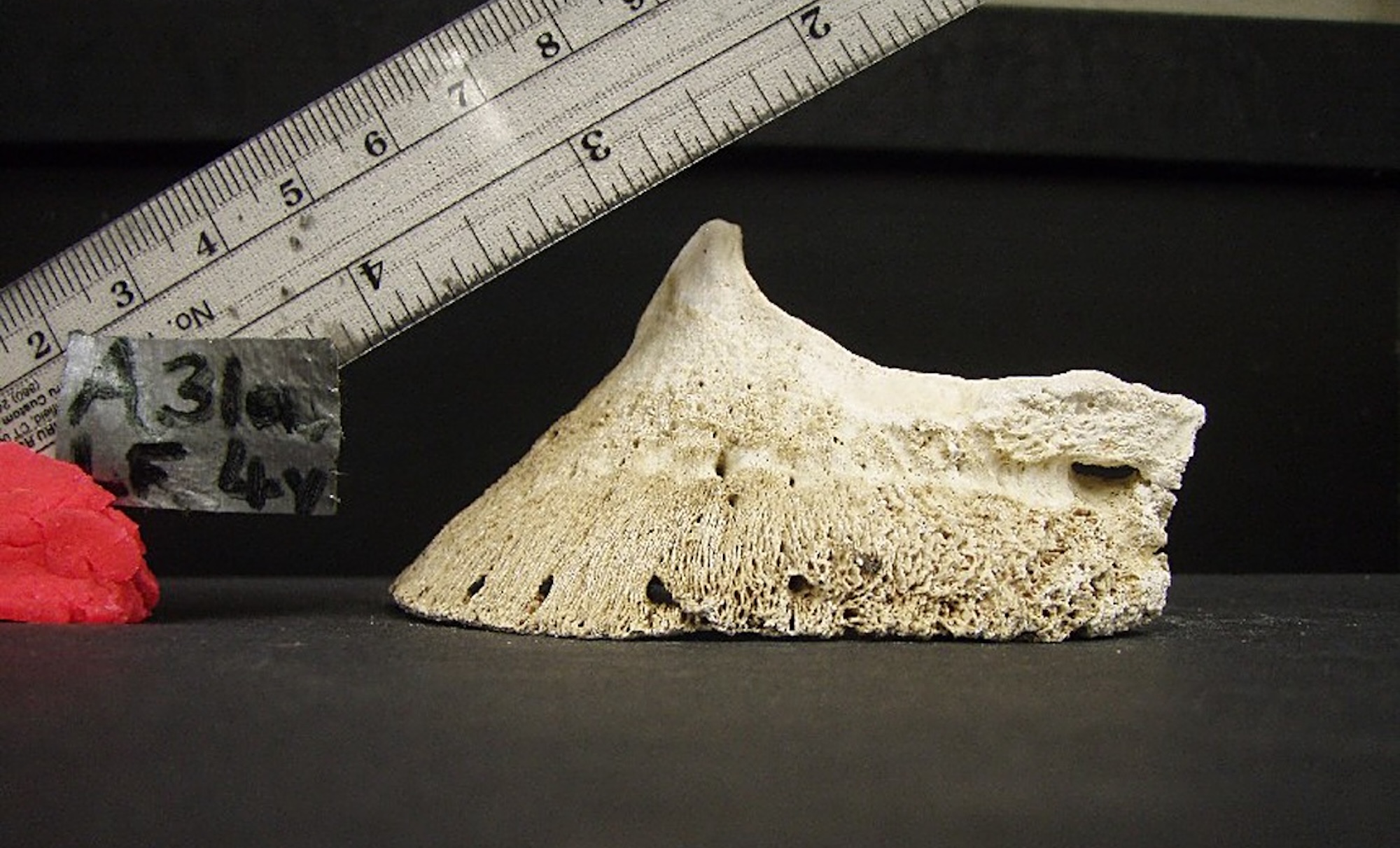 Dr Bowker: Osteoporotic Coffin Bones